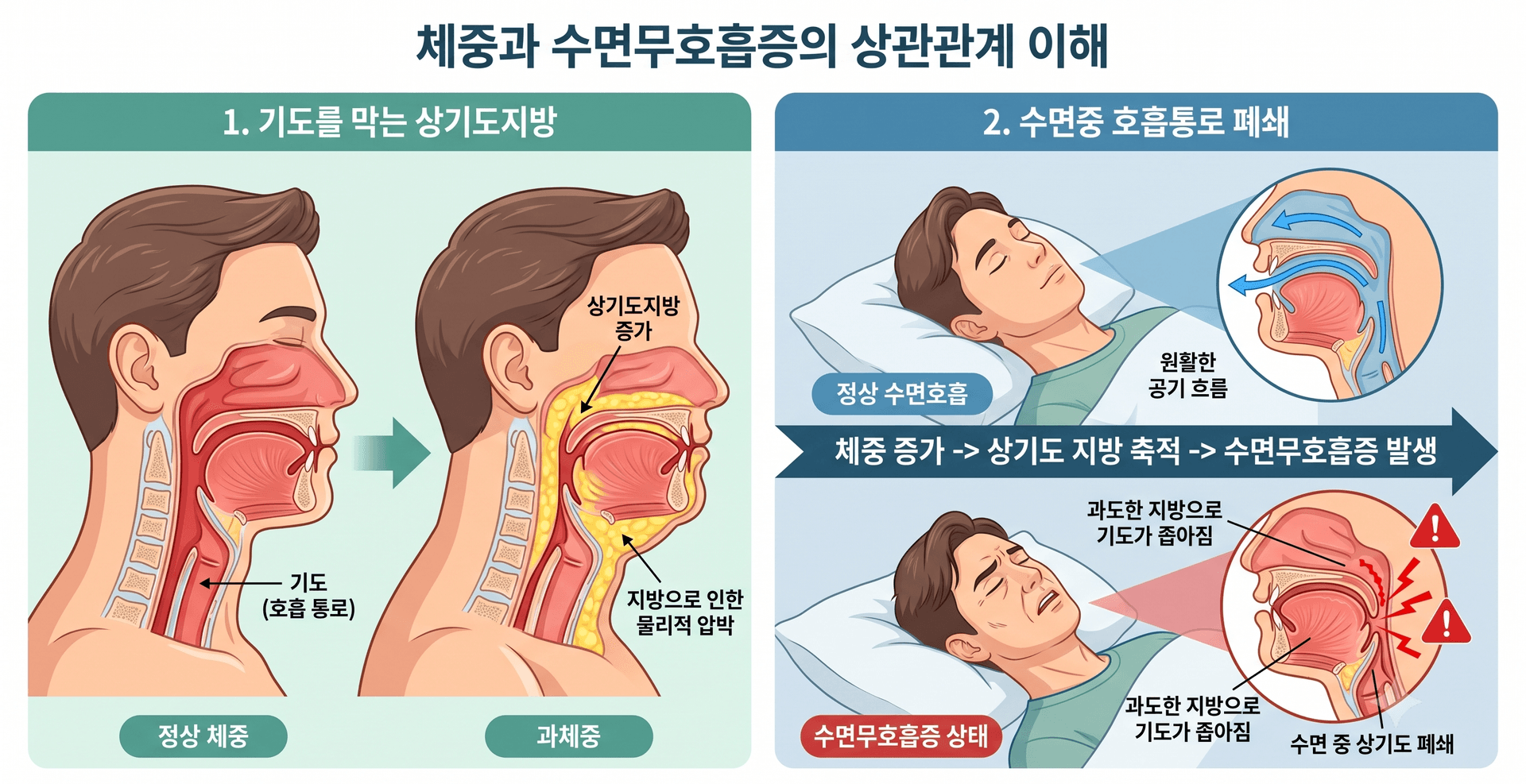 "살 빼는 주사가 코골이도 고친다?" 최근 승인된 비만 치료제의 수면무호흡증 개선 효과와 정밀 수면다원검사