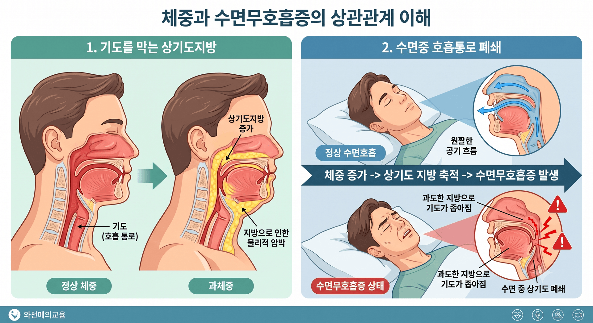 수면무호흡증 환자라면, 비만 주사 실비보험 적용 가능할까? (인천 수면다원검사, 인천 마운자로처방)